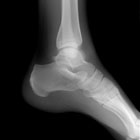 Inkjet Bone Repair